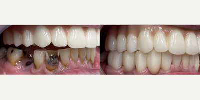 65-74 year old man treated with Porcelain Veneers, Mini Dental Implants, Smile Makeover - Treatment: Upper + Lower Restoration. Patient has an Upper Roundhouse, lower veneers, and our mini dental implants. Process: Consultation, decide on treatment, extract and place implants, and patient is to return for a post-op check. Results: Stunning, non-removable Zirconia bridge. Results will vary from patient to patient