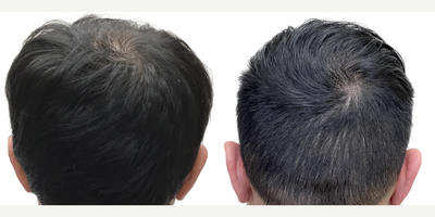 29 year old man treated with FUE Hair Transplant, Minoxidil and Finasteride - This is a gentleman who came to us at only age 29 for a hair transplant. His hair loss began in his early 20s and in only a few short years progressed to at least a Norwood Stage 5, or maybe beyond. He had never tried any evidence-based treatments to slow or reverse his hair loss. Despite his young age, he had complete obliteration of his hairline and front scalp, with near complete loss in the midscalp through to the crown. The result was disproportionate features, the loss of the frame to his face, and the appearance of being much older than his 29 years. Fortunately, he had an excellent donor area. Prior to surgery, we discussed the importance of supplementary non-surgical therapies like finasteride and minoxidil to help him preserve the hair he still had. In this way, we could use a hair transplant to replace what hes lost, knowing that hed be highly unlikely to lose additional hair in other areas. As a result of his large and dense donor area, we were able to perform a 3146 graft FUE surgery. This is one of the largest single session FUE surgeries ever performed at Toronto Hair Transplant Centre and is a larger graft amount for this type of surgery than average. You can see from our surgical drawings that his goal was not to achieve an overly aggressive hairline, but rather to have a natural hairline that preserved enough donor grafts to add some density in the midscalp and crown, while still giving him a frame to his face and good coverage upfront. He wanted the kind of hairline that would continue to look natural into his 30s, 40s, 50s and beyond. The majority of the grafts were distributed to the frontal scalp to rebuild the density there, while a few were added to the midscalp and crown. We knew this would not add overly thick density to those areas, but it would still make a significant difference. This patient returned to see us 13 months after his surgery. His results are absolutely amazing! He looks like, well, just a guy with hair! His forehead is much less prominent and he looks much more youthful and in line with his age. You can see in the detailed photo of his hairline that it looks completely natural and no one could ever tell hes had a hair transplant. His donor area continues to look dense without any noticeable evidence of even a large FUE harvest. He continues to use finasteride and minoxidil regularly, without any problems, and hasnt lost any additional hair. He looks great!