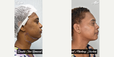 35-44 year old woman treated with Aqualyx, Botox, Kybella - i did double chin removal and marking jawline.