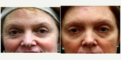 55-64 year old woman treated with Laser Resurfacing - 4 treatments of Three for Me