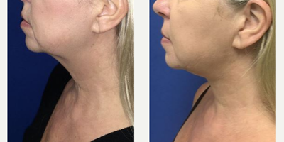 45-54 year old woman treated with Neck Lift - Patient had Lazerlift with Neck Lipo