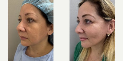 35-44 year old woman treated with Buccal Fat Removal - 43 y/o, 3 months after buccal cheek fat removal under sedation in our office.