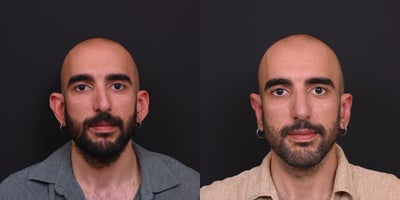 35-44 year old man treated with Rhinoplasty, Earlobe Repair - 35-44 year old man treated with Rhinoplasty, Earlobe Repair (Otoplasty)