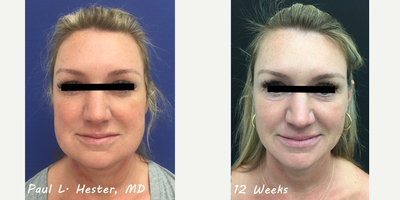 45-54 year old woman treated with FaceTite - FaceTite