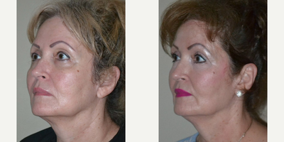 63 year old woman treated with Silhouette InstaLift - 63 year old woman treated with Silhouette InstaLift to cheeks, shown 1 year post op. She also had PDO Threads around the corners of her mouth as well as Facial Fat Transfer to her temporal areas, cheeks, infra orbital/tear troughs, and to her upper eyelid hollows. Post op, she had fuller cheeks, softer cheek curves, softer lower lid-cheek junction, and better defined angle of her jaw.