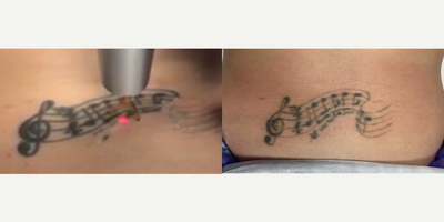 25-34 year old woman treated with Tattoo Removal - Tattoo removal progress during 1st session and after 2 sessions