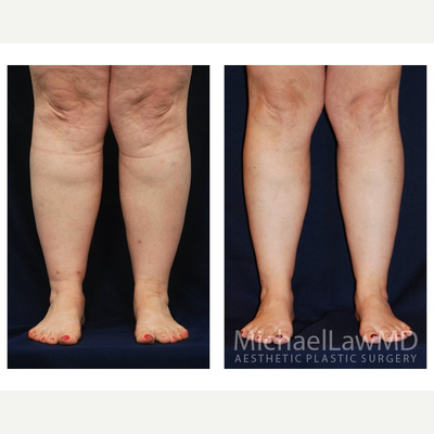 55-64 year old woman treated with Calf Reduction - Lower Leg Liposuction