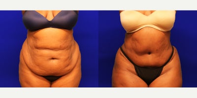 55-64 year old woman treated with Lipo 360, Tummy Tuck - The patient is a 60 year-old female who had concerns with her abdomen, flanks, back and bra line. Dr. Climov performed an abdominoplasty and liposuction to the flanks, back and bra line. The after results are 2.5 months post-procedure.