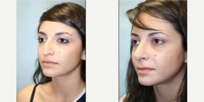 Woman treated with Rhinoplasty - Woman treated with Rhinoplasty.