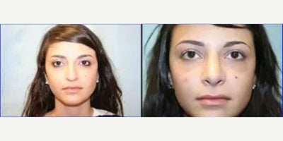 Woman treated with Rhinoplasty - Woman treated with Rhinoplasty.