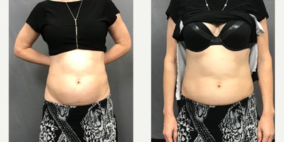 SculpSure - 55-64 year old woman treated with 3 treatments of sculpture