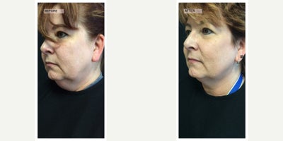 45-54 year old woman treated with CoolMini - CoolMini on the chin