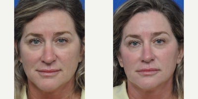 45-54 year old woman treated with Dermaplaning - This woman received the Dermaplaning Treatment, which is a full procedure that are treatments in this order:Cleanse; Exfoliating polish; Dermaplaning; Tone; Mask (customized); Daily Power Defense; Eye cream (customized); ZO sunblock + primer; Peptide lip therapy