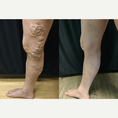 55-64 year old man treated with Sclerotherapy, VenaSeal - Before and after only 1 treatment of face sclerotherapy! Amazing results