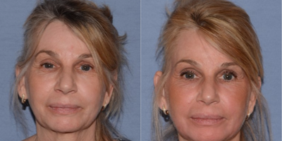 J-Plasma Helium Based Facial Resurfacing - J-Plasma facial rejuvenation resurfacing of spots, wrinkles and different pigments