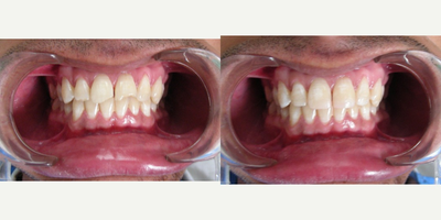 18-24 year old man treated with Tooth Repair - Front tooth fracture.