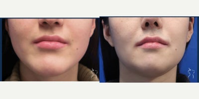 25-34 year old transgender woman treated with Transgender Facial Feminization Surgery - CHIN CONTOURING (REDUCTION GENIOPLASTY)