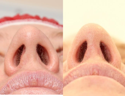 35-44 year old woman treated with Rhinoplasty - 35-44 year old woman treated with Rhinoplasty, shown 6 weeks post op.Rightnostril where the septum that was showing has been moved to the middle.