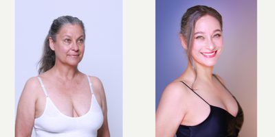 55-64 year old woman treated with MACS Facelift, AccuLift, Mini Neck Lift, Facelift, Breast Lift, Facial Fat Transfer - MACS Face Lift, Neck Lift and Breast Ptosis done by Dr. Lee Ji WonForehead Lift, Lower Blepharoplasty, Undereye Fat Repositioning done by Dr. Kim Seung Min