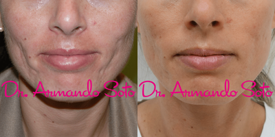 Woman treated with Microneedling - Woman treated with Microneedling