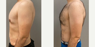 25-34 year old man treated with Gynecomastia Surgery, Male Tummy Tuck - 33 yo male s/p gynecomastia and male tummy tuck performed in our on site AAAA certified operating suite.