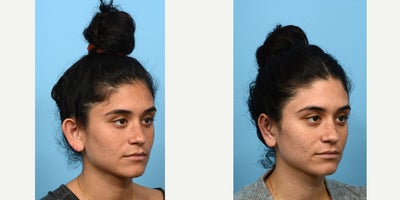 18-24 year old woman treated with Earfold, Ear Surgery - Having big ears is a common concern with a simple solution -- otoplasty, or ear surgery. Often times, overly projected ears are misconstrued as being disproportionately sized for a person's head. In truth, the issue lies in the way the ear is shaped, and by creating a new helical fold or adjusting the placement of the conchal bowl, the ears can be perceived to be much smaller. This was the case for this 24-year-old patient, who is thrilled with the outcome of her ear surgery with Dr. Wise.
