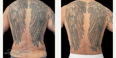 55-64 year old man treated with Abdominal Etching, Liposuction, Lymphatic Massage, Renuvion, Scar Removal, Skin Tightening, Vase - 55 year old gentleman who underwent VASER assisted liposculpting and Renuvion J plasma skin tightening of the abdomen, flanks, chest, axilla, lower back; chest masculinization procedure with fat grafting to the chest.
