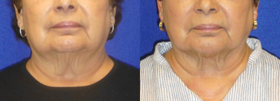 75 and up year old woman treated with CoolMini - Single day treatment for fat reduction and skin tightening at the chin and neck with CoolMini. Results were achieved in 4 months. To see results after 1 month, view the additional before and afters for this treatment.