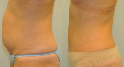 36 year old woman treated with Mommy Makeover - 36 year old female six months is shown following a Mommy Makeover with Mentor Moderate plus Saline implants ( 360 cc right, 330 cc left ) and a full Tummy Tuck using a progressive tension closure technique with no drain.