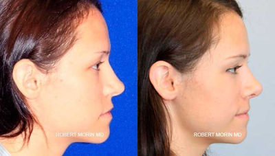 27 year old woman treated with Rhinoplasty - A tip rhinoplasty was performed on this 27 year old female who was unhappy with the appearance of her nose. Surgical correction of her bulbous tip was performed.