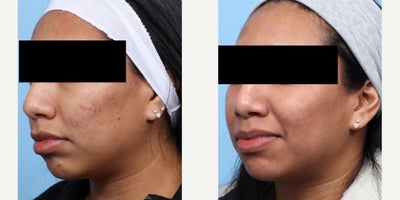 18-24 year old woman treated with SkinPen - After 2 sessions of SkinPen microneedling, this patient is on their way to smoother, clearer skin, with a noticeable reduction in acne scars. Her results are shown after 1 month after her second session. She is getting one more session and will have more improvement.
