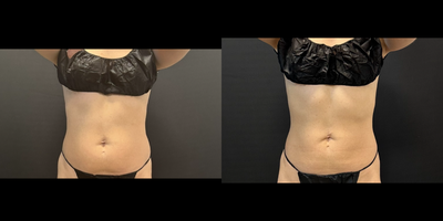 35-44 year old woman treated with CoolSculpting, CoolSculpting Elite - CoolSculpting results on Abdomen