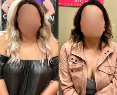 35-44 year old woman treated with Obalon Intragastric Balloon - 35-44 year old woman treated with Obalon Intragastric Balloon