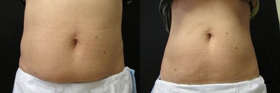 Vanquish Fat Female Abodmen - Vanquish Fat Abdominal Area