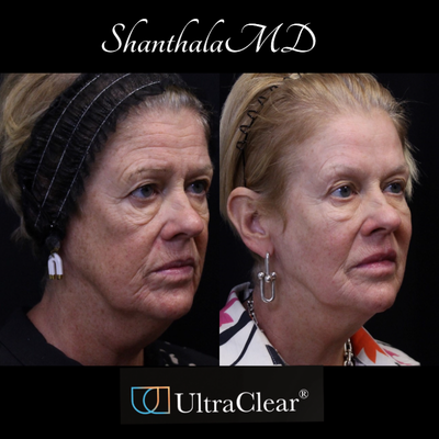 55-64 year old woman treated with CO2 Laser, Laser Resurfacing, Fractional Laser, - Life Changing Transformation with UltraClear Laser-Coring treatment at ShanthalaMD
