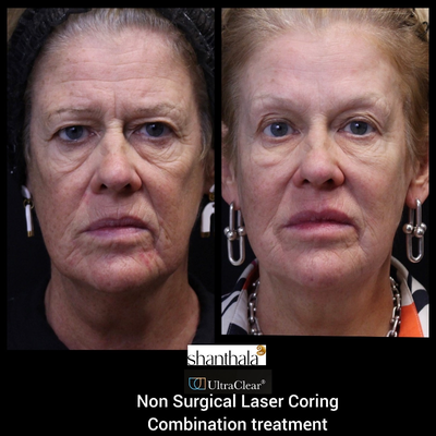 55-64 year old woman treated with CO2 Laser, Laser Resurfacing, Fractional Laser, - Life Changing Transformation with UltraClear Laser-Coring treatment at ShanthalaMD