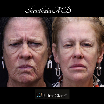 55-64 year old woman treated with CO2 Laser, Laser Resurfacing, Fractional Laser, - Life Changing Transformation with UltraClear Laser-Coring treatment at ShanthalaMD