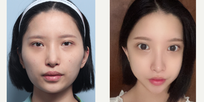 18-24 year old woman treated with Cheekbone Reduction, Jaw Reduction - Cheekbone ReductionJawline ReductionLateral Epicanthoplasty & Lower Hotz