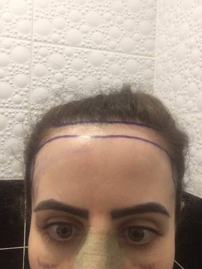 Hairline Lowering Istanbul Hairlines Review Realself