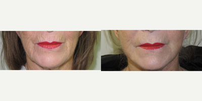 55-64 year old woman treated with Laser Resurfacing - Patient with upper lip and lower lip lines wanted to avoid repeat fillers and a more permanent solution to treatment of the wrinkles around her mouth. Fractional carbon dioxide laser resurfacing was used to treat these lines permanently.