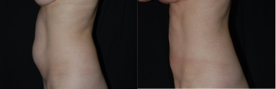 35-44 year old woman treated with Liposculpture - Liposculpture of the Abdomen and Breast Augmentation
