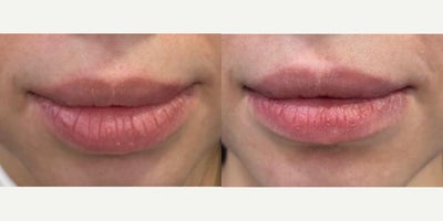 25-34 year old woman treated with Lip Reduction - Lower Lip Reduction surgery 7 weeks post operative