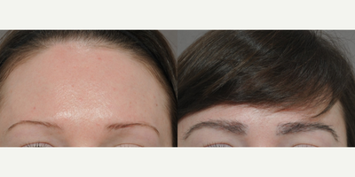 25 year old woman treated with FUT eyebrow transplant - Suffered from trichotillomania and thin eyebrows. Transplant created fullness to brows
