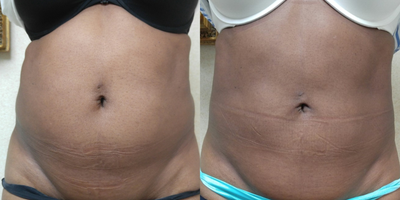 45-54 year old woman treated with Body Jet - 49 year-old approximately 2 years after body jet fat reduction