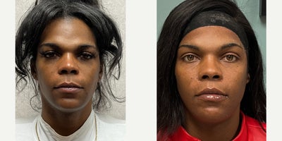 35-44 year old woman treated with Forehead Reduction, Facial Feminization Surgery, Brow Lift, Lip Lift, Genioplasty - This young woman underwent forehead feminization, lip surgery, and genioplasty.
