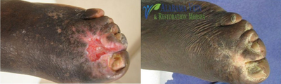 Woman treated with EVLT - Woman treated with EVLT