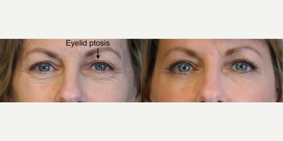 Woman treated with Fractional Laser - Woman treated with Fractional CO2Laser Resurfacing to improve wrinkling and skin around her eyesas well as Ptosis Repair for droopy upper eyelid