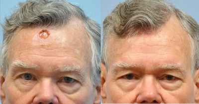 72 year old man with defect after skin cancer removal - Nearby skin was rearranged to reconstruct this area