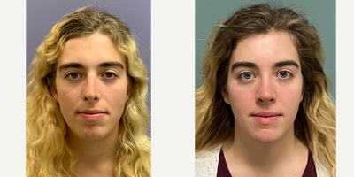 25-34 year old woman treated with Adam's Apple Reduction, Forehead Reduction, Brow Lift, Rhinoplasty, Transgender Facial Feminiz - this is a young lady who underwent facial feminization surgery including upper lip augmentation and mild volume of fat to cheeks).