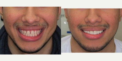 18-24 year old man treated with Dental Bonding - Direct composite veneers to close spaces between teeth. Done in one visit. To achieve more natural looking smile.